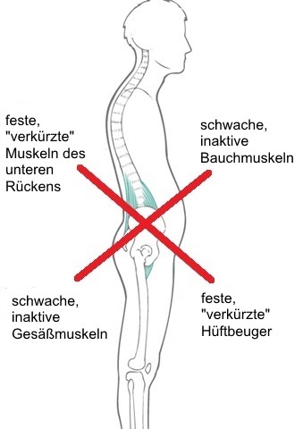 Rückenschmerzen und Hohlkreuz: Wie Betroffene nicht schlafen